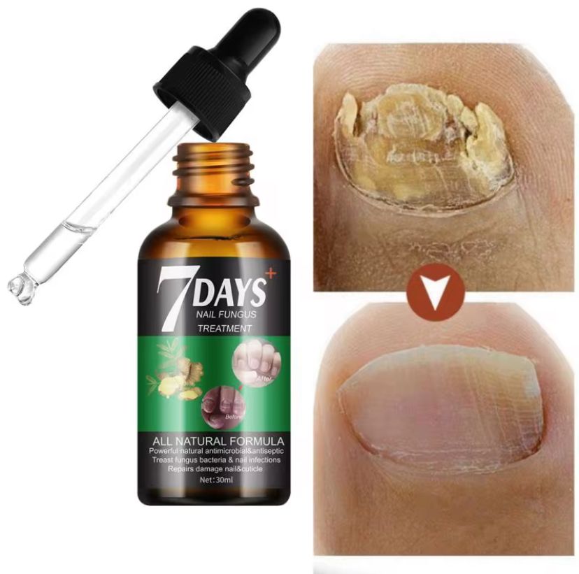 7 Days nail Fungus Treatement