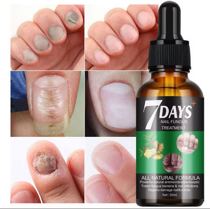 7 Days nail Fungus Treatement